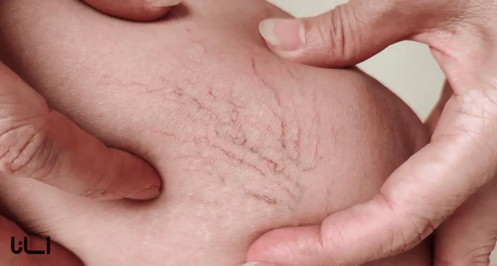 نکاتی که باید پیش از تمرین یوگا برای واریس بدانید